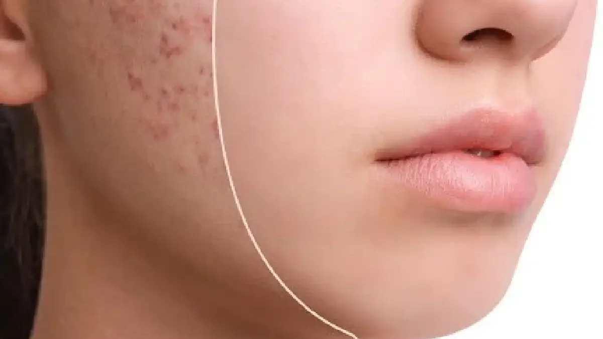Remove Pimples from the Face Effectively?
