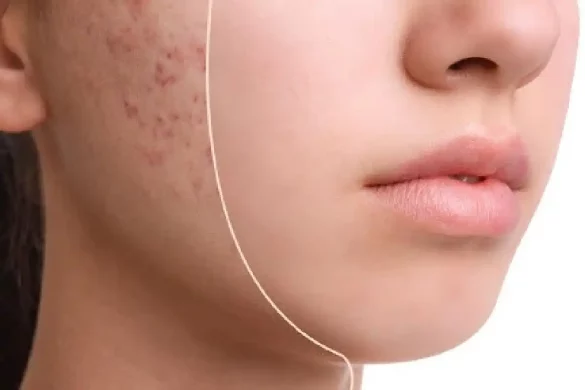 Remove Pimples from the Face Effectively_