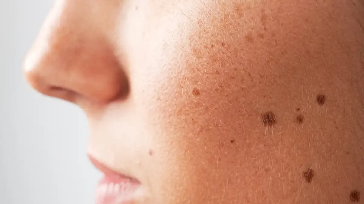 are beauty marks moles